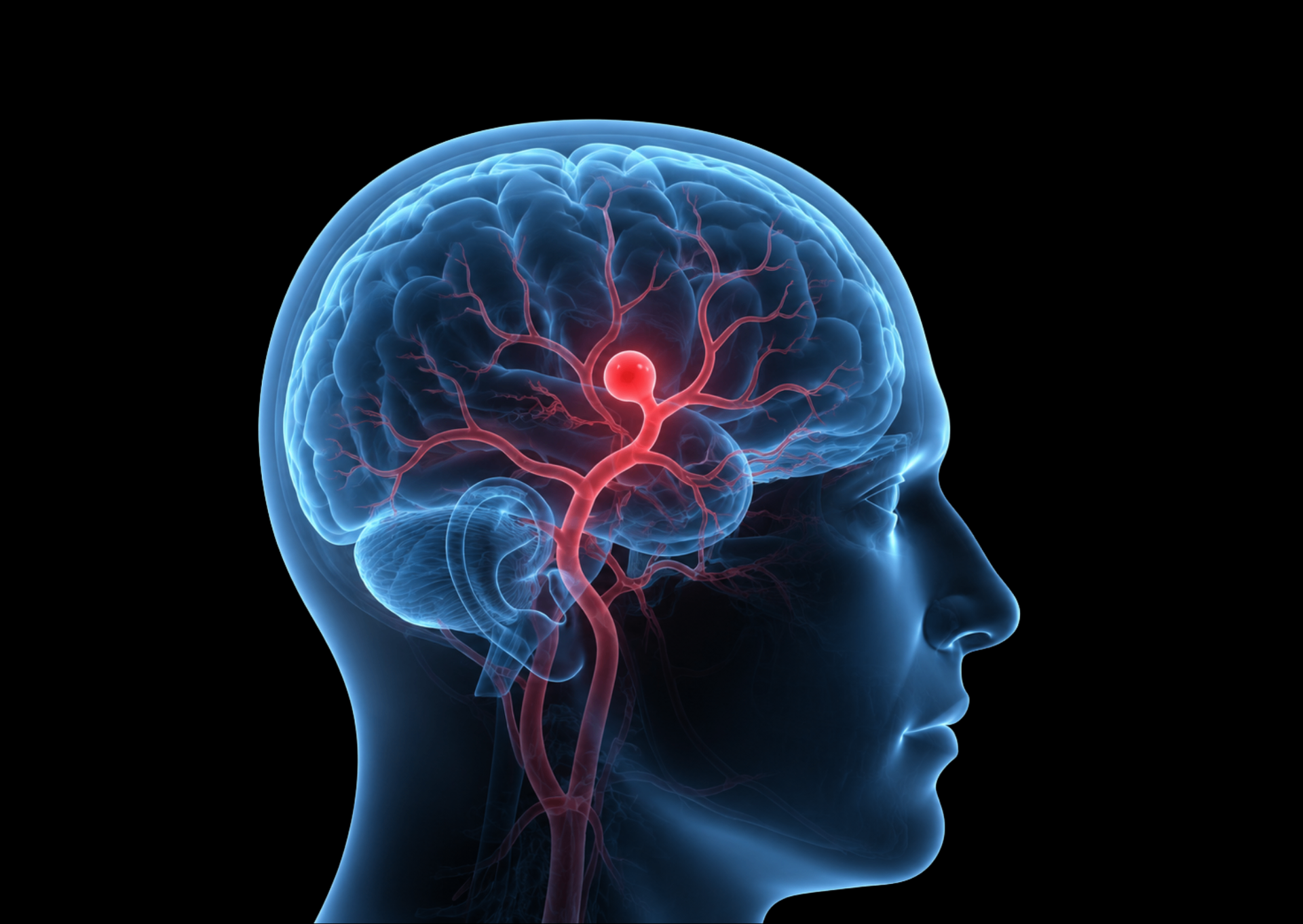 Aneurisma cerebral