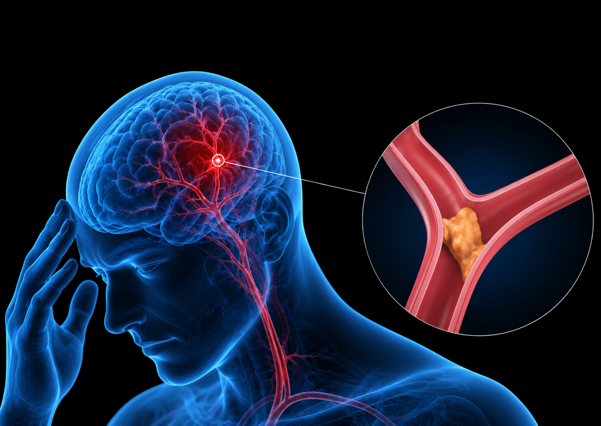 AVC e doenças da circulação cerebral